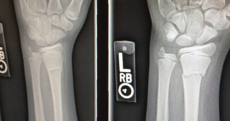 Schwache Knochen oder gar schon Beinbruch Schwache Knochen oder gar schon Beinbruch