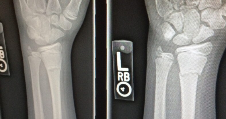 Schwache Knochen oder gar schon Beinbruch Schwache Knochen oder gar schon Beinbruch