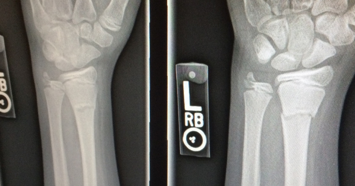 Schwache Knochen oder gar schon Beinbruch Schwache Knochen oder gar schon Beinbruch